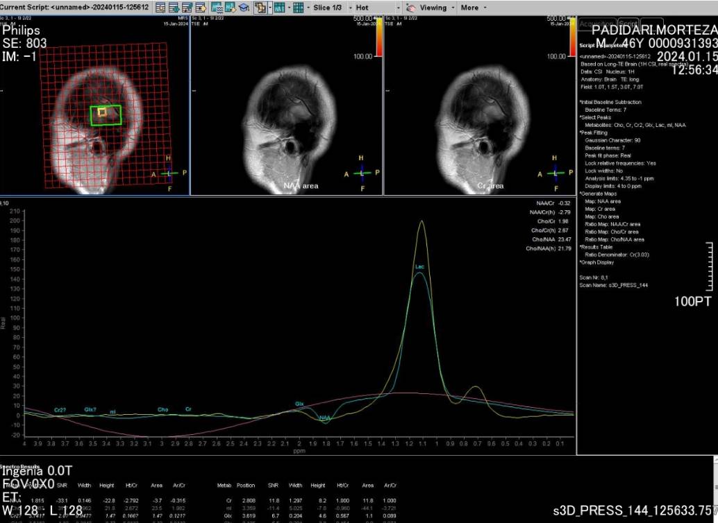 راه اندازی MRI پیشرفته بررسی ضایعات مغزی در مرکز آموزشی و درمانی پورسینا