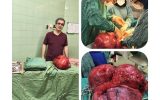 خارج کردن توده سنگین از شکم بیمار گیلانی