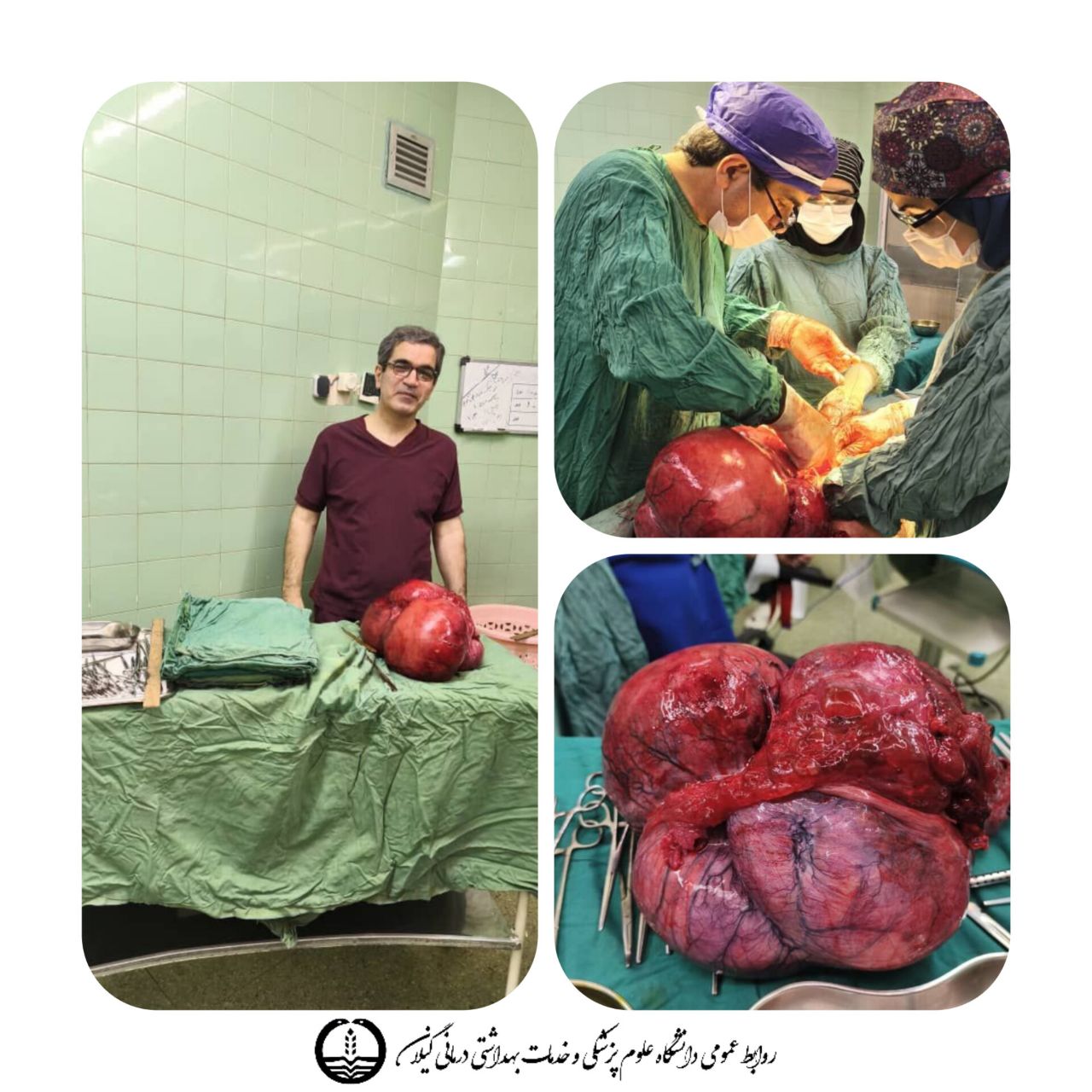 خارج کردن توده سنگین از شکم بیمار گیلانی